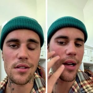 Partiellement paralysé du visage, Justin Bieber révèle son diagnostic inquiétant