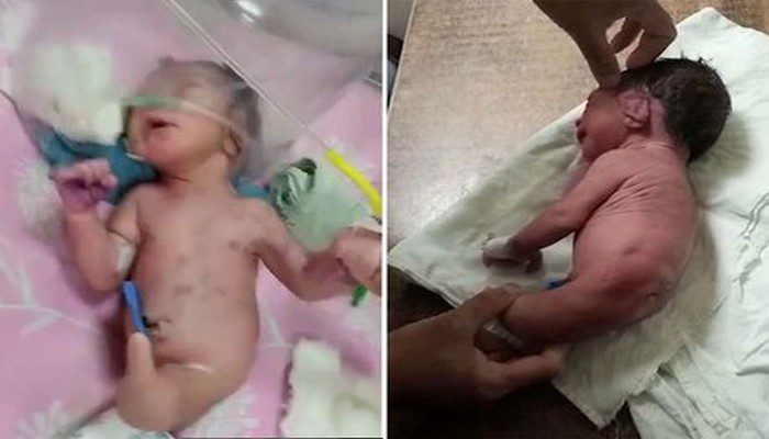(Photos) : Un bébé né avec une corne étrange au lieu de jambes laisse les médecins perplexes