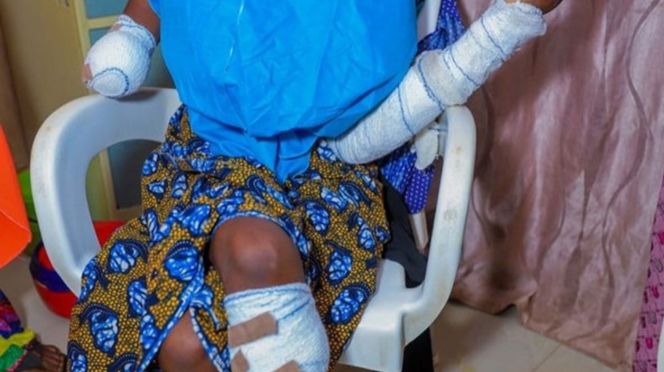 Forcée à se marier à 17 ans : Son mari lui c0upe une main et une jambe