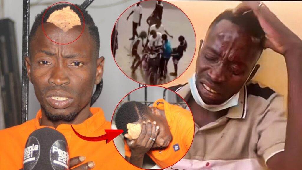 (Vidéo) – Sauvagement agress3, Mbaye Kouthia confie : « Dagn ma door brique… »