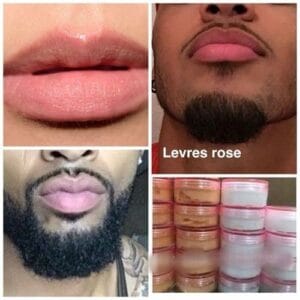 Dépigmentation des parties intimes et des lèvres : une tendance dangereuse observée au Sénégal