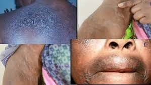 Dépigmentation au Sénégal : l’inquiétante révélation d’une dermatologue