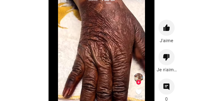 (Vidéo) – La main abimée de cette fille de 19 ans  causée par le « Khessal » fait le buzz