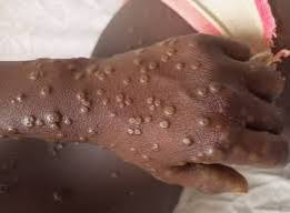 Épidémie de Variole du singe : Le Sénégal en alerte