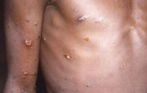 Premier cas de Mpox au Sénégal : le ministère de la Santé appelle au calme…