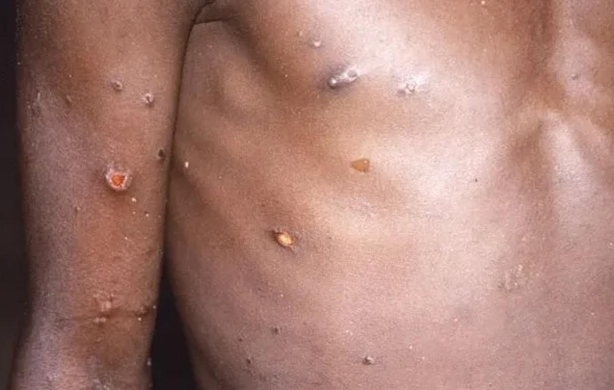 Premier cas de Mpox au Sénégal : le ministère de la Santé appelle au calme…