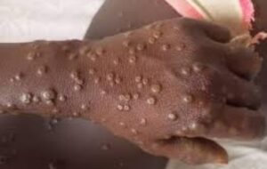 Santé : après un premier cas de Mpox, 25 contacts identifiés et surveillés…