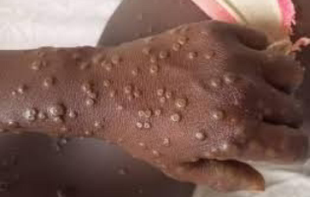 Santé : après un premier cas de Mpox, 25 contacts identifiés et surveillés…