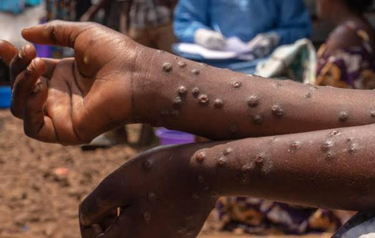 Fièvre de la Vallée du Rift et Mpox : le ministère de la Santé annonce une progression…