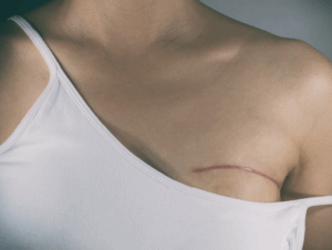 Cancer du sein : mastectomie et reconstruction le même jour