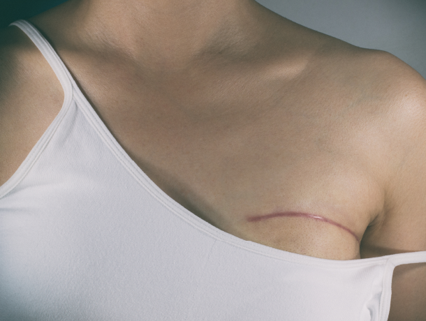 Cancer du sein : mastectomie et reconstruction le même jour