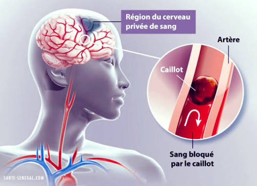 Alerte AVC au Sénégal : Le Pr Ngor Side Diagne tire la sonnette d’alarme sur nos habitudes alimentaires