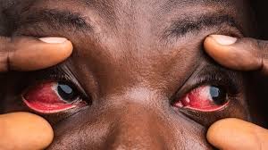 Yeux rouges, douleurs et contagion : Ce qu&rsquo;il faut savoir face à la montée de la conjonctivite