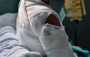 Mariage interdit par la caste à Podor : Elle s&rsquo;ébouillante de désespoir et lutte contre la mørt