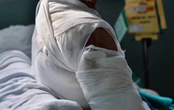 Mariage interdit par la caste à Podor : Elle s’ébouillante de désespoir et lutte contre la mørt